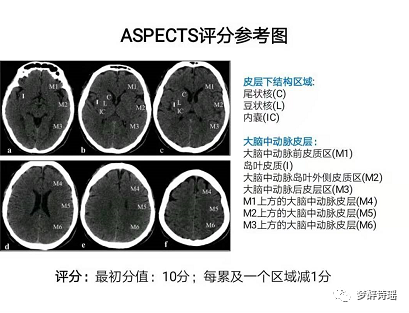 ASPECTS分区说明